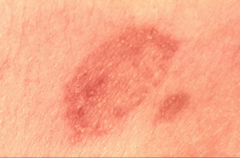 Sedef Hastalığı ve Cilt Sağlığı: Mantarı ve Sinir Sistemi Bağlantısı